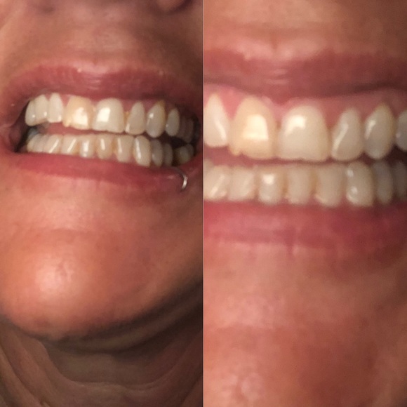 The best whitening toothpaste I have ever used!!! - Picture 5 of 7